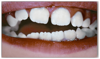 Лингвальные смещения зубов формирующие неправильный прикус