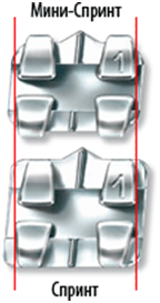 Брекет-системы: виды металлических брекетов